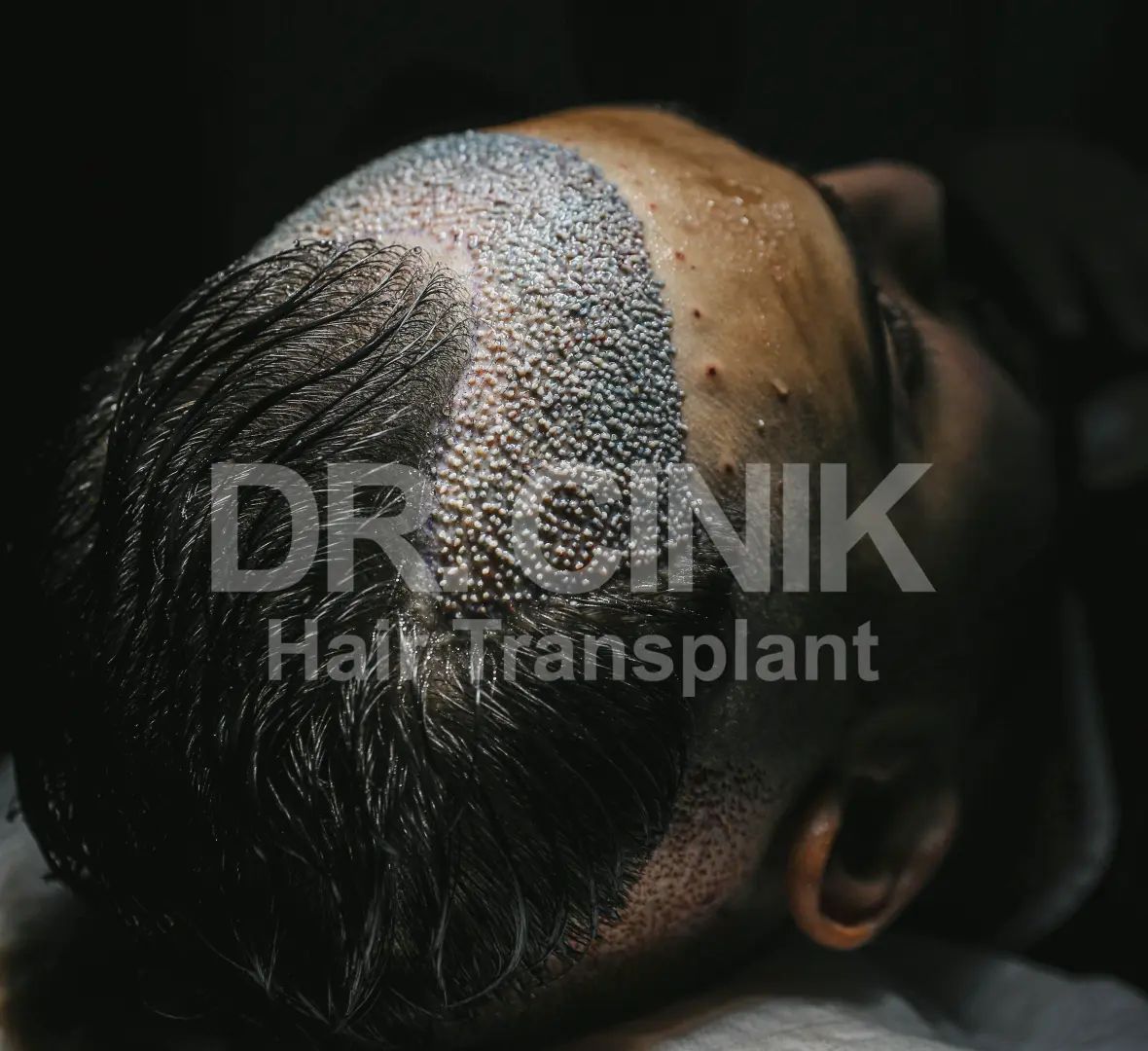 Hair Transplant Without Shaving