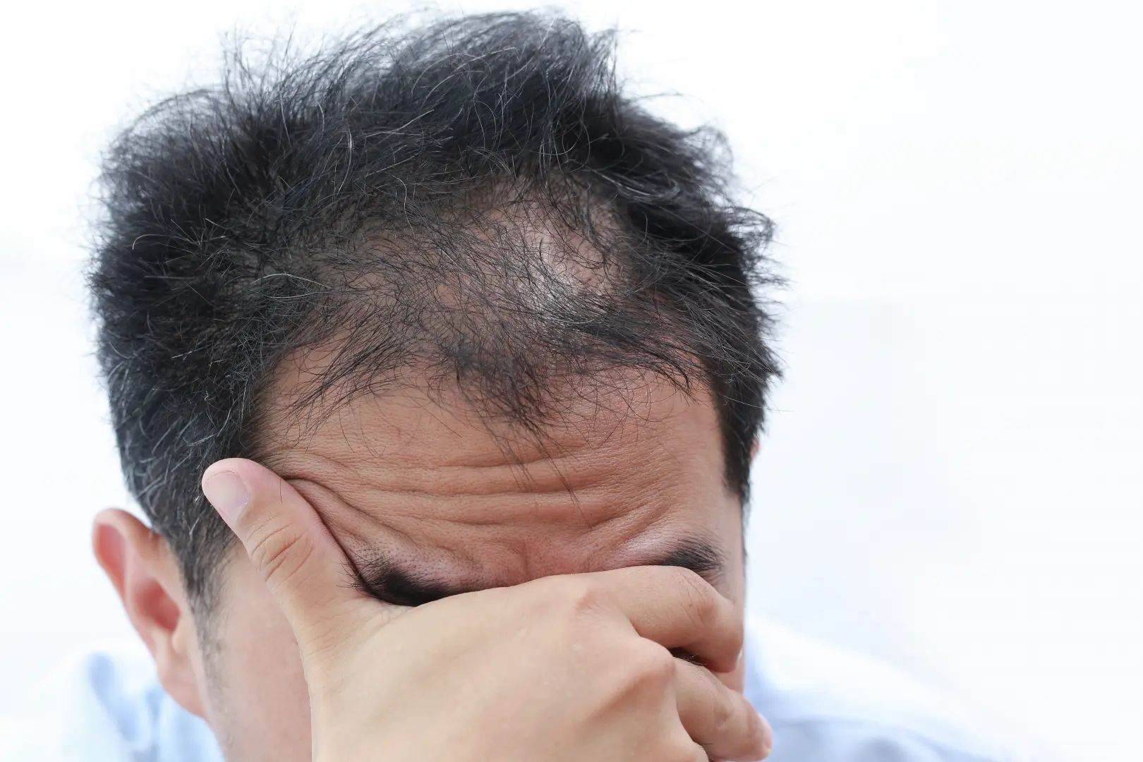 Hair Loss Psychological Effects (2)